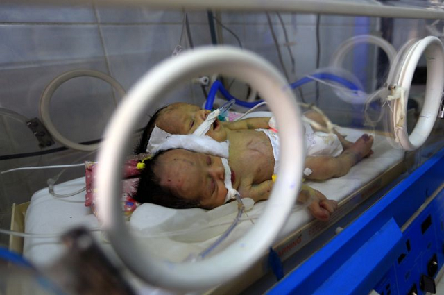 the twin boys shared a kidney and a pair of legs but had separate hearts and lungs photo afp