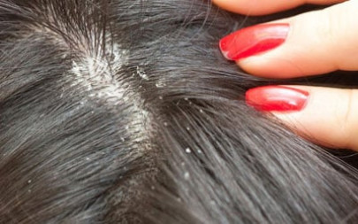 five effective ways to rid you of your dandruff problem
