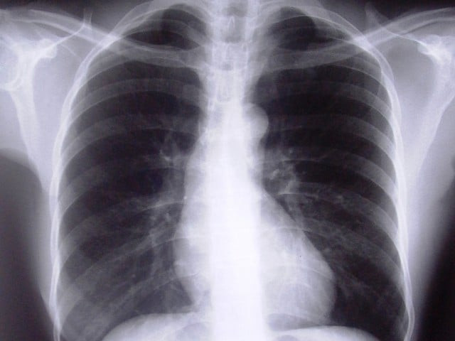 according to available data the incidence of tb per 100 000 in pakistan is 181 photo file according to available data the incidence of tb per 100 000 in pakistan is 181 photo file