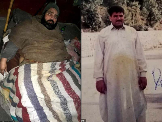 muhammad mushtaq has elephantiasis caused by a parasitic infection photo mail online muhammad mushtaq has elephantiasis caused by a parasitic infection photo mail online