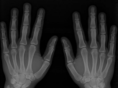 kth hosts pelvic fracture workshop kth hosts pelvic fracture workshop