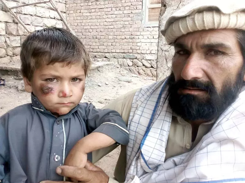 a child suffering from leishmaniasis in shewa town of north waziristan photo express a child suffering from leishmaniasis in shewa town of north waziristan photo express