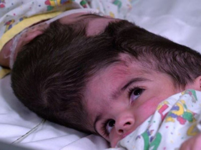 pakistani conjoined twins undergo successful surgery in uk