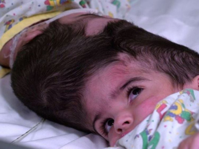 safa marwa ullah born with condition known as 039 craniopagus 039 in which parts of brains are joined photo great ormond street hospital safa marwa ullah born with condition known as 039 craniopagus 039 in which parts of brains are joined photo great ormond street hospital