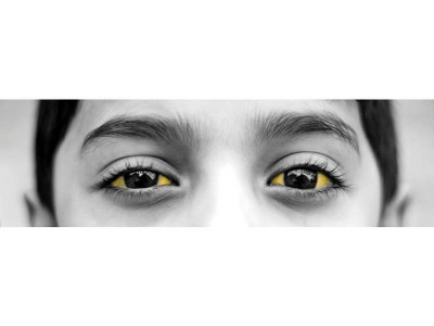 a hepatitis epidemic simmers in sindh a hepatitis epidemic simmers in sindh