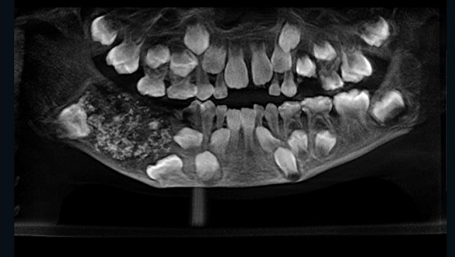 an x ray of the mouth showed the sac filled with 039 abnormal teeth 039 embedded in the seven year old boy 039 s mouth source cnn an x ray of the mouth showed the sac filled with 039 abnormal teeth 039 embedded in the seven year old boy 039 s mouth source cnn