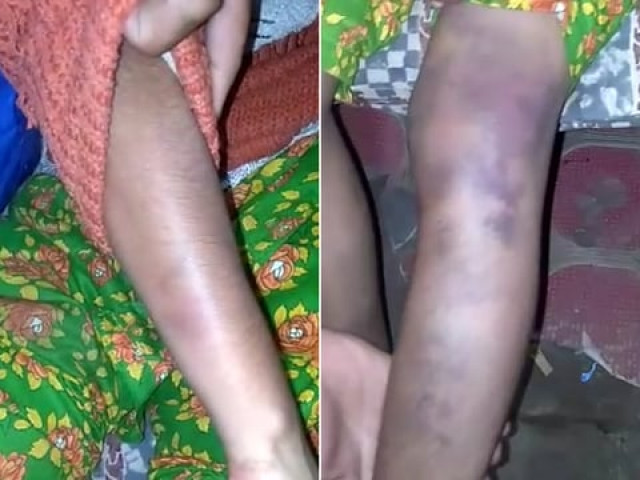 the victim shows the injuries when local police found her photos express the victim shows the injuries when local police found her photos express