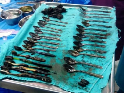 jewellery spoons and toothbrushes found in man s stomach