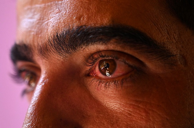 abid khan one of the many victims of torture inflicted on kashmiris by the indian army in iok photo afp abid khan one of the many victims of torture inflicted on kashmiris by the indian army in iok photo afp