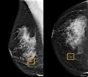 study finds google system could improve breast cancer detection study finds google system could improve breast cancer detection