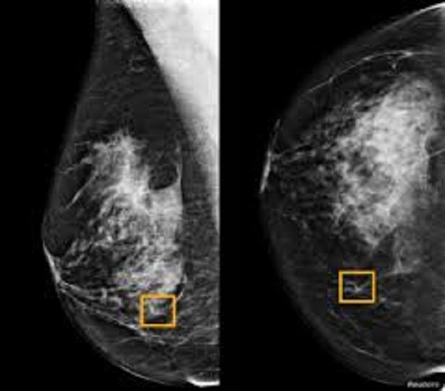 a yellow box indicates where an artificial intelligence ai system found cancer hiding inside breast tissue in an undated photo released by northwestern university in chicago january 1 2020 photo reuters