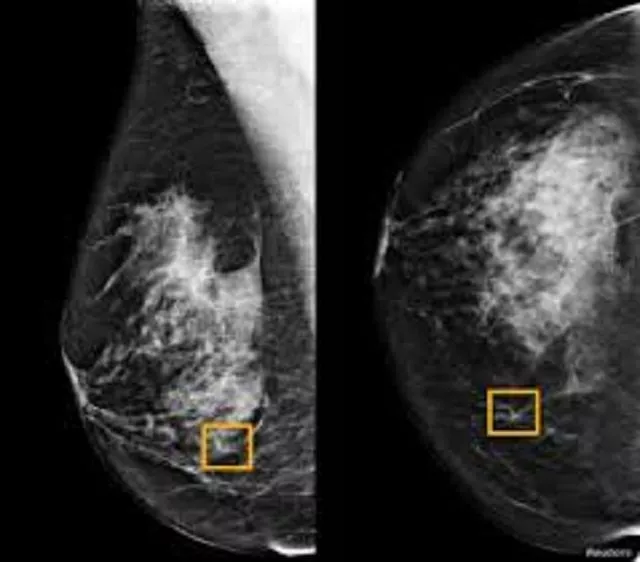 a yellow box indicates where an artificial intelligence ai system found cancer hiding inside breast tissue in an undated photo released by northwestern university in chicago january 1 2020 photo reuters a yellow box indicates where an artificial intelligence ai system found cancer hiding inside breast tissue in an undated photo released by northwestern university in chicago january 1 2020 photo reuters