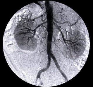 closure of lithotripsy unit at civil hospital worries patients