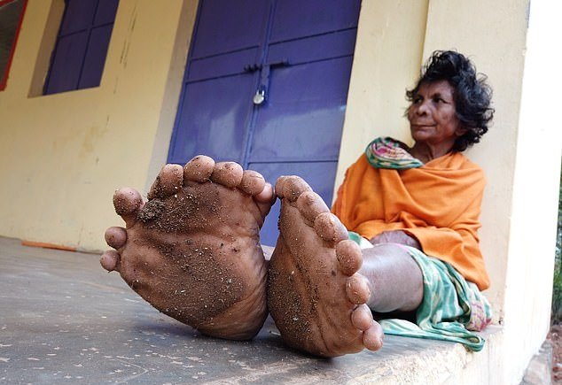 woman with 19 toes 12 fingers sets new world record