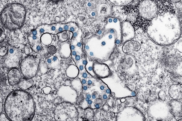 covid 19 is seen in a transmission electron microscopic image obtained from the centers for disease control cdc in atlanta georgia us photo reuters