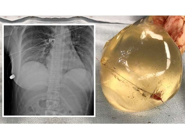 the 30 year old 039 s left breast implant deflected the bullet away from her vital organs into the other breast photo sage medical journal the 30 year old 039 s left breast implant deflected the bullet away from her vital organs into the other breast photo sage medical journal