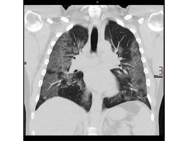 100 children die of pneumonia every hour 100 children die of pneumonia every hour