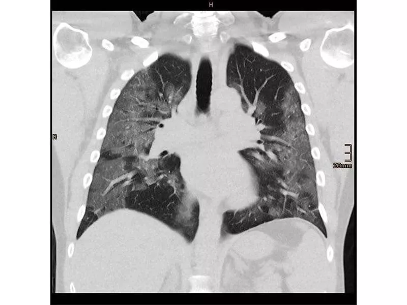 100 children die of pneumonia every hour 100 children die of pneumonia every hour