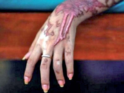 man arrested for acid attack on estranged girlfriend