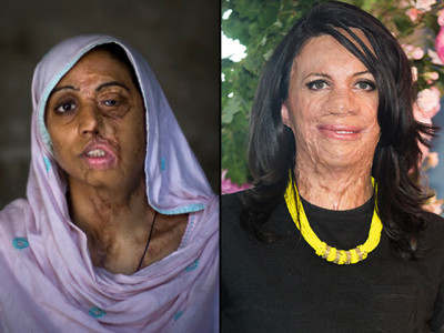will pakistani acid victims ever be as lucky as turia pitt