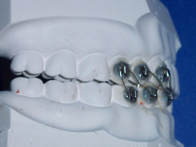 would you get your jaw wired to lose weight would you get your jaw wired to lose weight