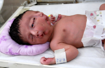 in rawalpindi a baby with two faces fights for survival in rawalpindi a baby with two faces fights for survival