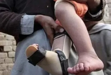 first wild polio case of 2026 confirmed in sindh