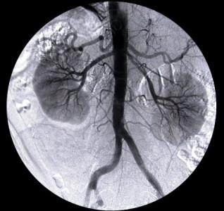 illegal kidney transplants rich doctors on bail in violation of judicial policy