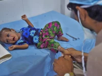 malnutrition costs country rs4 76tr annually