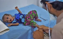 malnutrition costs country rs4 76tr annually malnutrition costs country rs4 76tr annually