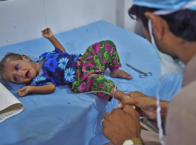 malnutrition costs country rs4 76tr annually