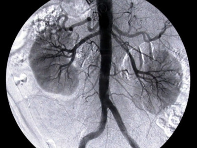 labourer loses kidney to illegal transplant racket labourer loses kidney to illegal transplant racket