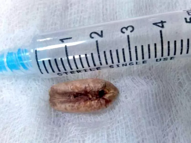 a view of the date seed that was removed from the minor s windpipe by the doctors through bronchoscopy technique pho to express a view of the date seed that was removed from the minor s windpipe by the doctors through bronchoscopy technique pho to express