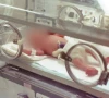 nurse blamed for infant s thumb loss