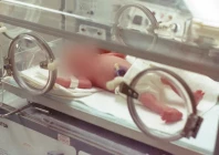 nurse blamed for infant s thumb loss