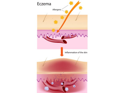 health tips ditch the itch