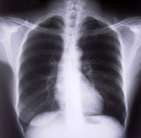 vitamin d doesn t ease lung disease symptoms study vitamin d doesn t ease lung disease symptoms study