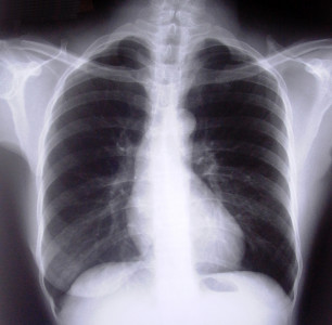 world tuberculosis day pakistan ranks sixth among tb hit countries