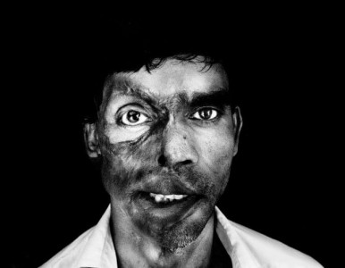whether the victim is a man or woman acid attacks are no laughing matter