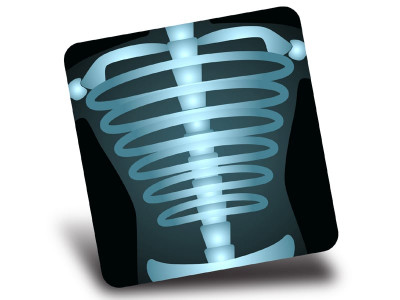 tb diagnosis x ray scans unavailable until release of funds