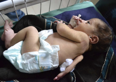 third arm of baby successfully removed