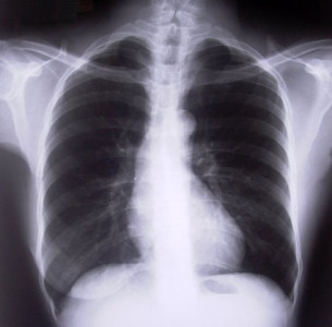 government begins anti pneumonia drive
