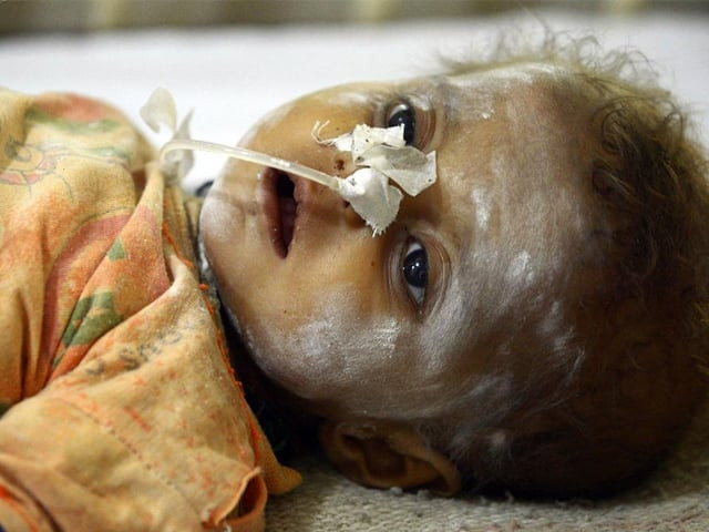 a child lays on a hospital bed in the desert region of tharparkar photo afp a child lays on a hospital bed in the desert region of tharparkar photo afp