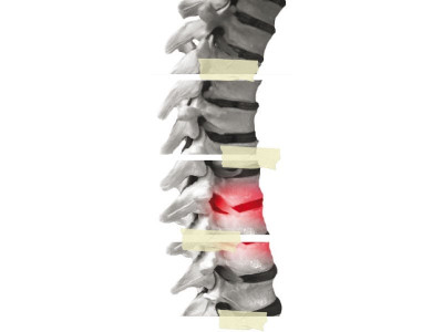 speedy recovery paraplegic centre to offer free spine surgery
