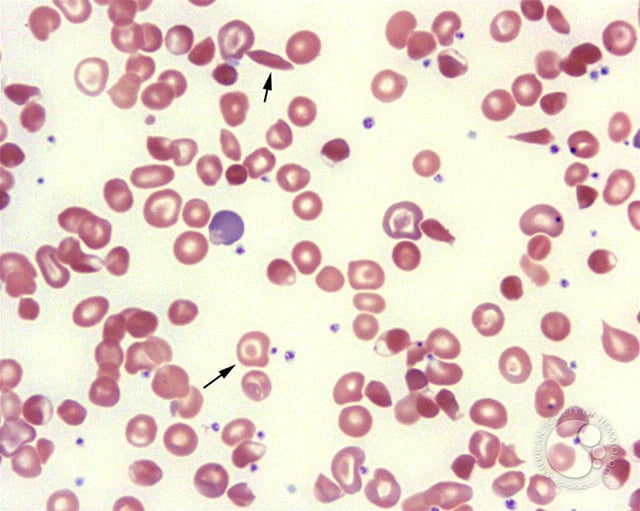 peripheral smear from a patient with s thalassemia photo american society of hematology