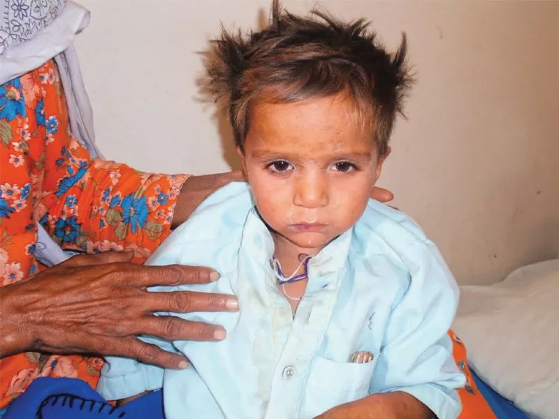 several children who were vaccinated earlier have contracted measles doctors claim it may be due to their immune system photo express several children who were vaccinated earlier have contracted measles doctors claim it may be due to their immune system photo express