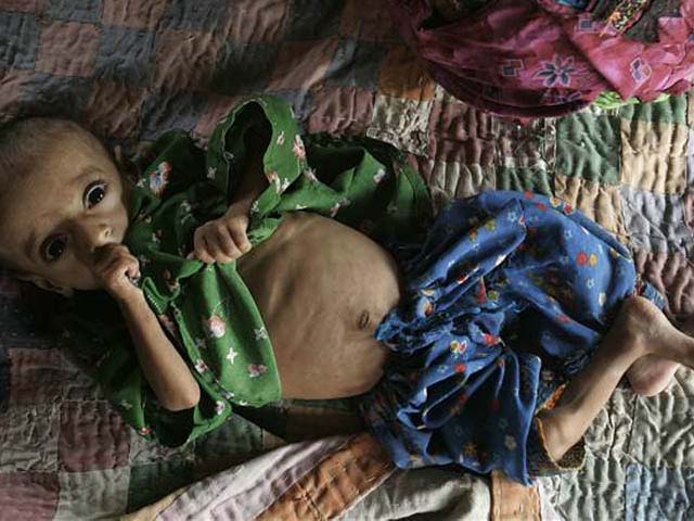 a malnourished pakistani girl heleema at a camp for displaced people in sukkur sindh province southern pakistan photo aaron favila