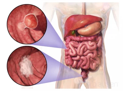 colorectal ranks third most common cancer type globally colorectal ranks third most common cancer type globally