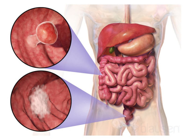 colorectal ranks third most common cancer type globally