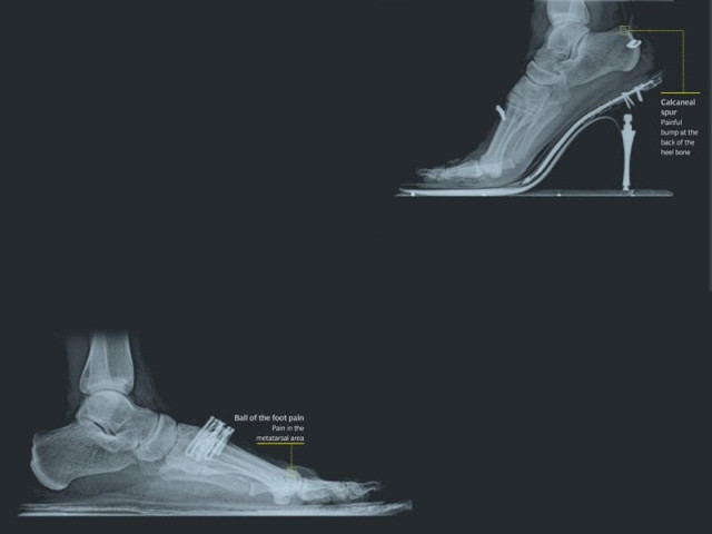 high heels throw you forward putting pressure on the front of the foot an x ray of a right foot in kolhapuri chappals which lead to flat feet or loss of the arch images radiologist nasiruddin at south city hospital high heels throw you forward putting pressure on the front of the foot an x ray of a right foot in kolhapuri chappals which lead to flat feet or loss of the arch images radiologist nasiruddin at south city hospital